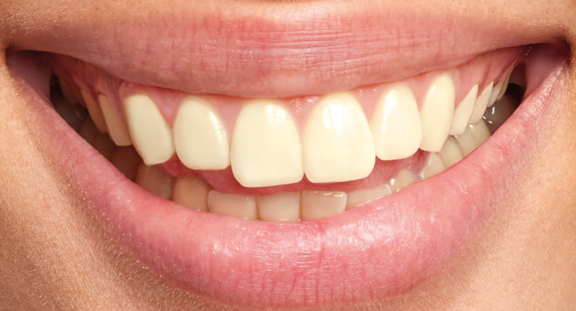 branqueamento antes orto m