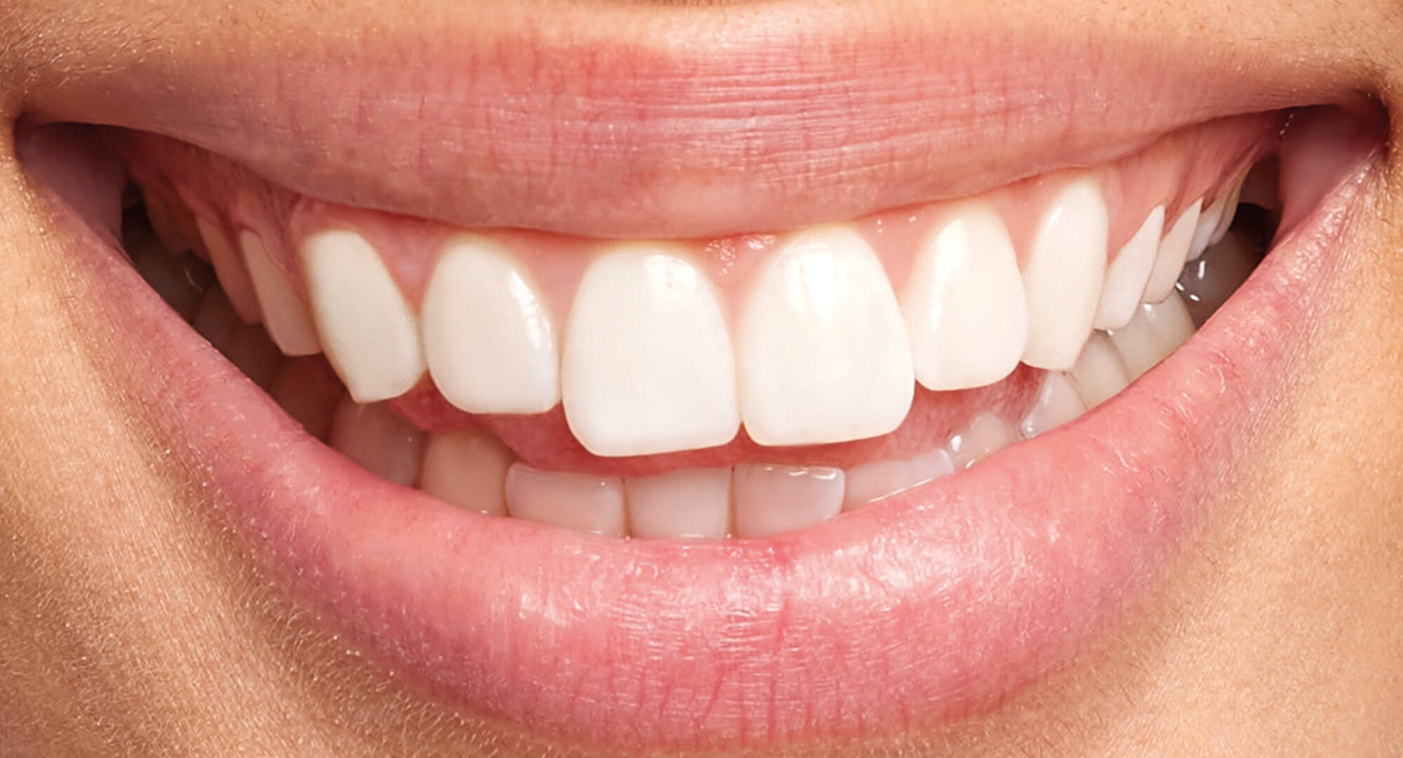 branqueamento depois orto m